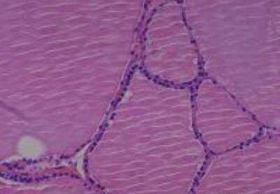 Hematoxylin & Eosin Stain: Human Various Tissue MicroArray (Cancer) [NBP2-30233] -  28. Thyroid