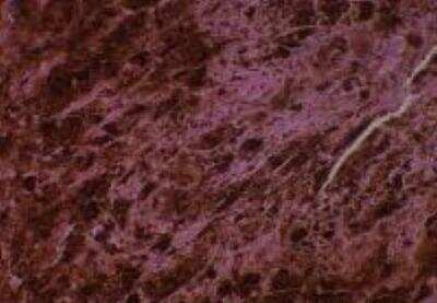 Hematoxylin & Eosin Stain: Human Various Tissue MicroArray (Cancer) [NBP2-30233] -  32. Skin malignant melanoma