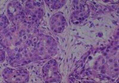 Hematoxylin & Eosin Stain: Human Various Tissue MicroArray (Cancer) [NBP2-30233] -  34.  Breast ductal carcinoma in situ