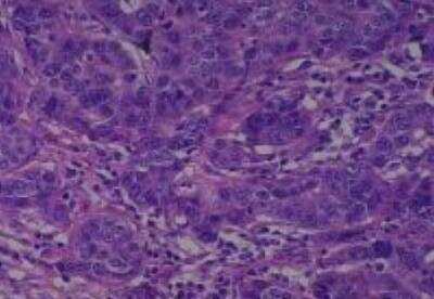 Hematoxylin & Eosin Stain: Human Various Tissue MicroArray (Cancer) [NBP2-30233] - 35. Breast infiltrating duct carcinoma