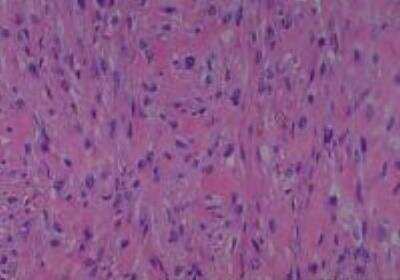 Hematoxylin & Eosin Stain: Human Various Tissue MicroArray (Cancer) [NBP2-30233] -  37. Bone osteosarcoma