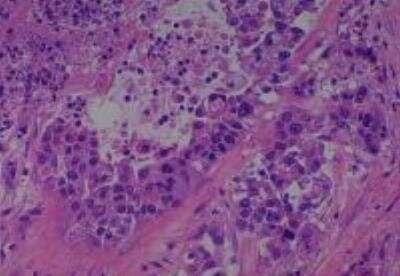 Hematoxylin & Eosin Stain: Human Various Tissue MicroArray (Cancer) [NBP2-30233] - 38. Lung adenocarcinoma