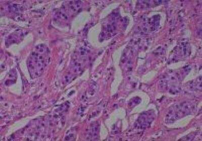 Hematoxylin & Eosin Stain: Human Various Tissue MicroArray (Cancer) [NBP2-30233] - 51. Urinary bladder transitional cell carcinoma