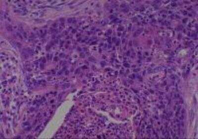 Hematoxylin & Eosin Stain: Human Various Tissue MicroArray (Cancer) [NBP2-30233] - 54. Uterine cervix squamous cell carcinoma