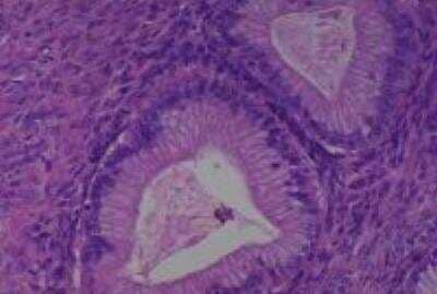 Hematoxylin & Eosin Stain: Human Various Tissue MicroArray (Cancer) [NBP2-30233] -  57. Ovary,  mucinous cystadenocarcinoma