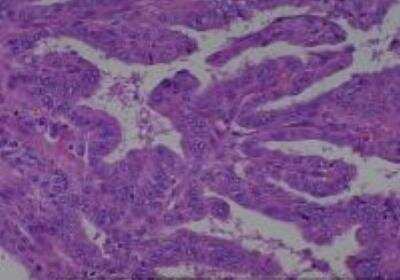 Hematoxylin & Eosin Stain: Human Various Tissue MicroArray (Cancer) [NBP2-30233] - 59. Thyroid papillary carcinoma