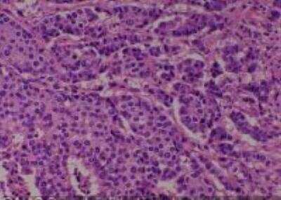 Hematoxylin & Eosin Stain: Human Various Tissue MicroArray (Cancer) [NBP2-30234] - 13. Breast infiltrating Duct Carcinoma