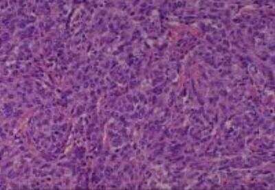 Hematoxylin & Eosin Stain: Human Various Tissue MicroArray (Cancer) [NBP2-30234] - 14. Lung Squamous Cell Carcinoma