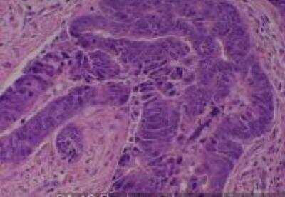 Hematoxylin & Eosin Stain: Human Various Tissue MicroArray (Cancer) [NBP2-30234] - 19. Rectum Adenocarcinoma