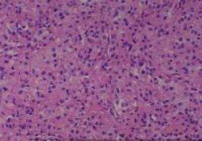 Hematoxylin & Eosin Stain: Human Various Tissue MicroArray (Cancer) [NBP2-30234] -  20. Kidney Renal Cell Carcinoma