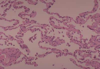 Hematoxylin & Eosin Stain: Human Various Tissue MicroArray (Cancer) [NBP2-30234] - 05. Normal lung