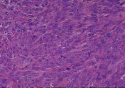 Hematoxylin & Eosin Stain: Human Various Tissue MicroArray (Cancer) [NBP2-30328] - 1. Skin Malignant Melanoma