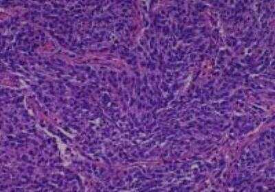 Hematoxylin & Eosin Stain: Human Various Tissue MicroArray (Cancer) [NBP2-30328] -  15. Lung Squamous cell Carcinoma, Poorly differentiated