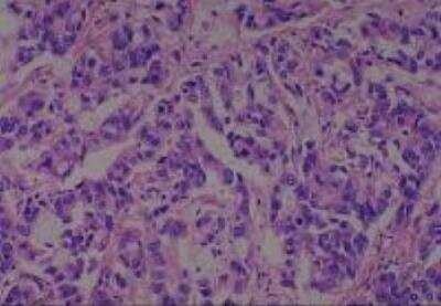 Hematoxylin & Eosin Stain: Human Various Tissue MicroArray (Cancer) [NBP2-30328] - 24. Pancreas Adenocarcinoma, moderately differentiated