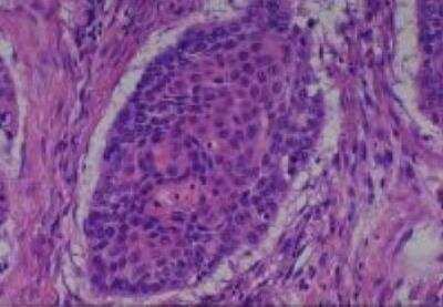 Hematoxylin & Eosin Stain: Human Various Tissue MicroArray (Cancer) [NBP2-30328] -  25. Esophagus squamous cell carcinoma