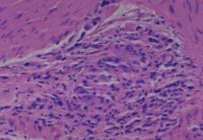 Hematoxylin & Eosin Stain: Human Various Tissue MicroArray (Cancer) [NBP2-30328] -  28. Stomach adenocarcinoma, Poorly differentiated