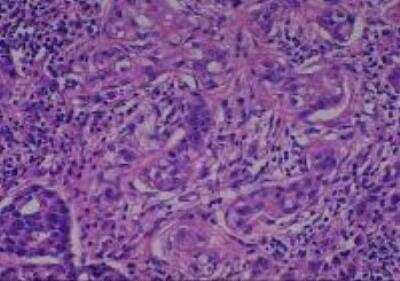 Hematoxylin & Eosin Stain: Human Various Tissue MicroArray (Cancer) [NBP2-30328] -  29. Stomach adenocarcinoma, Poorly differentiated