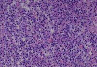 Hematoxylin & Eosin Stain: Human Various Tissue MicroArray (Cancer) [NBP2-30328] -  31. Stomach malignant Lymphoma, Differentiated