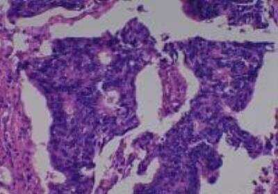 Hematoxylin & Eosin Stain: Human Various Tissue MicroArray (Cancer) [NBP2-30328] - 38. Rectum adenocarcinoma , Moderately differentiated