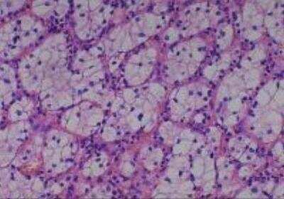 Hematoxylin & Eosin Stain: Human Various Tissue MicroArray (Cancer) [NBP2-30328] - 40. Kidney Renal cell Carcinoma