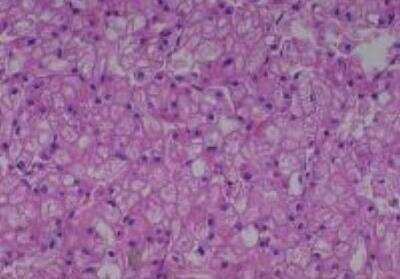 Hematoxylin & Eosin Stain: Human Various Tissue MicroArray (Cancer) [NBP2-30328] -  41. Kidney Renal cell carcinoma