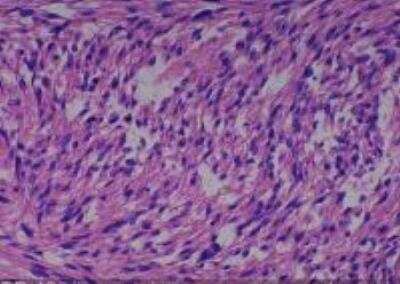 Hematoxylin & Eosin Stain: Human Various Tissue MicroArray (Cancer) [NBP2-30328] -  48. Uterus Leiomyosarcoma, Metastasis