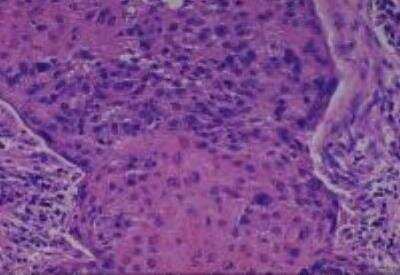 Hematoxylin & Eosin Stain: Human Various Tissue MicroArray (Cancer) [NBP2-30328] -  49. Uterine cervix, squamous cell carcinoma