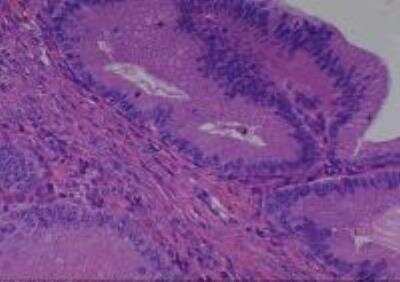 Hematoxylin & Eosin Stain: Human Various Tissue MicroArray (Cancer) [NBP2-30328] -  52. Ovary mucinous cystadenocarcinoma