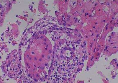 Hematoxylin & Eosin Stain: Human Various Tissue MicroArray (Cancer) [NBP2-30328] -  02.  Skin squamous cell carcinoma