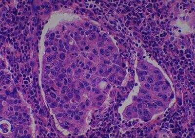 Hematoxylin & Eosin Stain: Human Various Tissue MicroArray (Cancer) [NBP2-30328] -  03. Breast infiltrating duct carcinoma