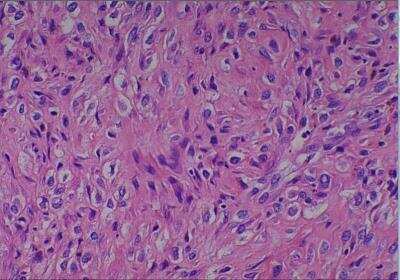 Hematoxylin & Eosin Stain: Human Various Tissue MicroArray (Cancer) [NBP2-30328] -  08. Bone osteosarcoma, fibroblastic type