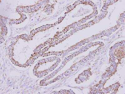 Immunohistochemistry-Paraffin: Hyaluronidase 1/HYAL1 Antibody [NBP1-32465] - Paraffin-embedded Endometrial CA, using antibody at 1:500 dilution.