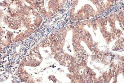 Immunohistochemistry-Paraffin: Hyaluronidase 1/HYAL1 Antibody [NBP2-16906] - Human endometrial carcinoma. HYAL1 stained by HYAL1 antibody diluted at 1:500.Antigen Retrieval: Citrate buffer, pH 6.0, 15 min.