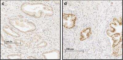Immunohistochemistry: Hypoxic Post-Translational Modification Antibody Pack [NBP1-78948] - HIF-1alpha expression in PDAC and adjacent normal pancreatic tissue. PDAC with weak (intensity 1) nuclear and cytoplasmic HIF-1alpha staining (left). PDAC with strong (intensity 3) nuclear and moderate (intensity 2) cytoplasmic HIF-1alpha staining (right). Image collected and cropped by CiteAb from the following publication (//wjso.biomedcentral.com/articles/10.1186/s12957-018-1432-4), licensed under a CC-BY license. HIF-1 alpha Antibody (H1alpha67) [NB100-105]