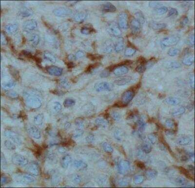 Immunohistochemistry: Hypoxic Post-Translational Modification Antibody Pack [NBP1-78948] - Analysis of FIH in human renal cancer using DAB with hematoxylin counterstain. Factor Inhibiting HIF-1 Antibody (162c) [NBP1-30333]