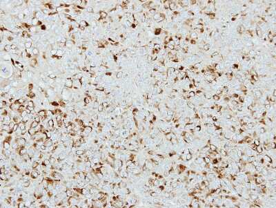 Immunohistochemistry-Paraffin: ICA1 Antibody [NBP2-16909] - Immunohistochemical analysis of paraffin-embedded A2780-CP70 xenograft, using antibody at 1:100 dilution.