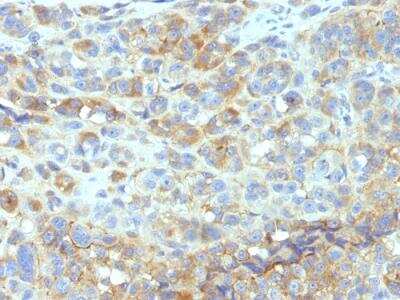 Immunohistochemistry-Paraffin: ICAM-1/CD54 Antibody (W-CAM-1 (same as Wehi-CAM-1 or 1H4)) - IHC-Prediluted [NBP2-48214] - Formalin-fixed, paraffin-embedded human Melanoma stained with CD54 Monoclonal Antibody (W-CAM-1).
