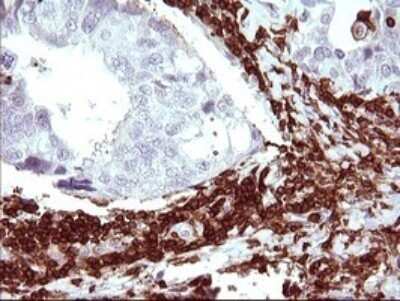 Immunohistochemistry: ICAM-3/CD50 Antibody (OTI1E7) - Azide and BSA Free [NBP2-70975] - Analysis of Adenocarcinoma of Human breast tissue. (Heat-induced epitope retrieval by 10mM citric buffer, pH6.0, 120C for 3min)