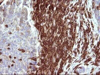 Immunohistochemistry: ICAM-3/CD50 Antibody (OTI1E7) - Azide and BSA Free [NBP2-70975] - Analysis of Carcinoma of Human lung tissue.(Heat-induced epitope retrieval by 10mM citric buffer, pH6.0, 120C for 3min)