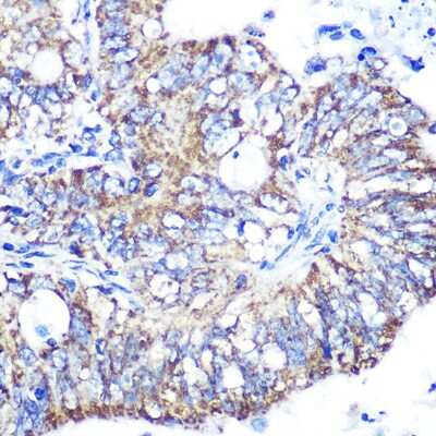 Immunohistochemistry-Paraffin: IDH2 Antibody (8C3D4) [NBP3-15366] - Immunohistochemistry of paraffin-embedded human colon carcinoma using IDH2 Rabbit mAb (NBP3-15366) at dilution of 1:100 (40x lens).Perform microwave antigen retrieval with 10 mM PBS buffer pH 7.2 before commencing with IHC staining protocol.