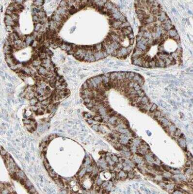 Immunohistochemistry-Paraffin: IDH2 Antibody [NBP1-85784] - Staining of human colorectal cancer shows strong granular cytoplasmic positivity in tumor cells.