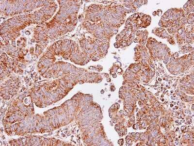 Immunohistochemistry-Paraffin: IDH3A Antibody [NBP1-32396] -  Human lung SCC, using IDH3A antibody at 1:100 dilution. Antigen Retrieval: Trilogy™ (EDTA based, pH 8.0) buffer, 15min.