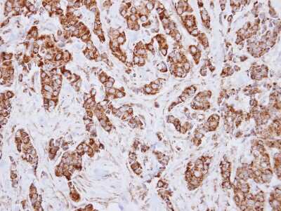 Immunohistochemistry-Paraffin: IDH3A Antibody [NBP2-16916] - Immunohistochemical analysis of paraffin-embedded Breast ca, using antibody at 1:250 dilution.