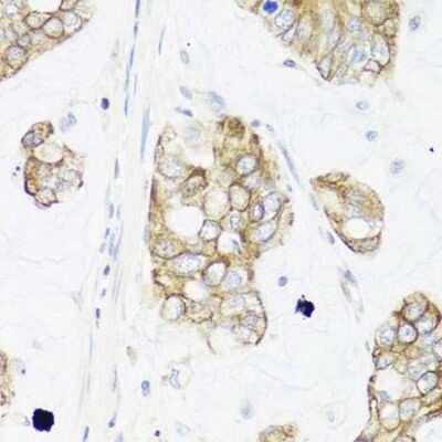 Immunohistochemistry-Paraffin: IER3 Antibody [NBP3-03948] - Paraffin-embedded human gastric cancer using IER3 antibody at dilution of 1:100 (40x lens).