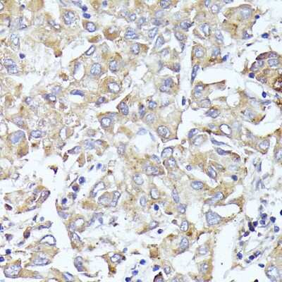 Immunohistochemistry-Paraffin: IF3EI Antibody [NBP3-03375] - Paraffin-embedded human liver cancer using IF3EI antibody at dilution of 1:100 (40x lens).