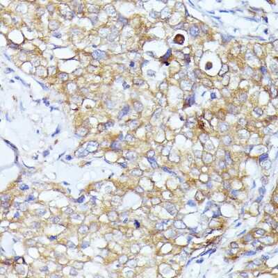 Immunohistochemistry-Paraffin: IF3EI Antibody [NBP3-03375] - Paraffin-embedded human mammary cancer using IF3EI antibody at dilution of 1:100 (40x lens).