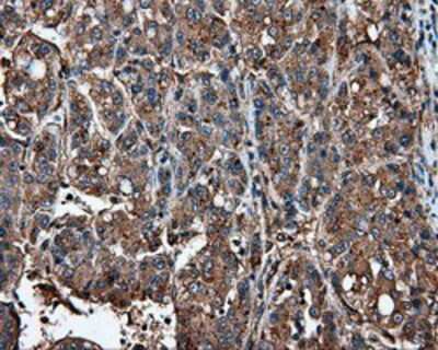 Immunohistochemistry-Paraffin: IFIT1 Antibody (OTI3G8) [NBP2-02340] -  Staining of paraffin-embedded Carcinoma of Human liver tissue using anti-IFIT1 mouse monoclonal antibody.