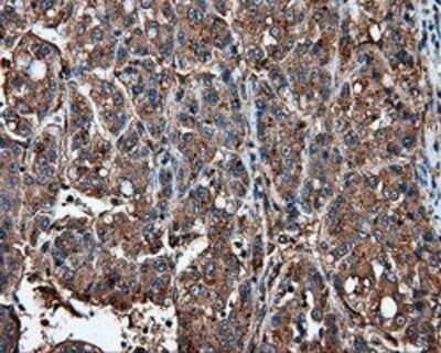 Immunohistochemistry: IFIT1 Antibody (OTI3G8) - Azide and BSA Free [NBP2-71005] - Staining of paraffin-embedded Carcinoma of Human liver tissue using anti-IFIT1 mouse monoclonal antibody.