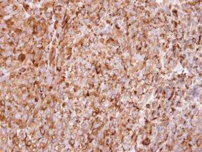 Immunohistochemistry-Paraffin: IFN-alpha 2 Antibody [NBP2-42866] - CL1-5 xenograft, using interferon alpha 2 antibody at 1:100 dilution. Antigen Retrieval: Trilogy™ (EDTA based, pH 8.0) buffer, 15min.