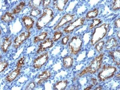 Immunohistochemistry-Paraffin: IFN-gamma Antibody (IFNG/466) - Azide and BSA Free [NBP2-54394] - Formalin-fixed, paraffin-embedded human Renal Cell Carcinoma stained with Interferon gamma Monoclonal Antibody (IFNG/466)